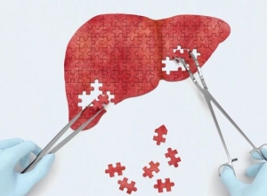 Làm cách nào để phát hiện sớm bệnh xơ gan? Đọc ngay trước khi quá muộn